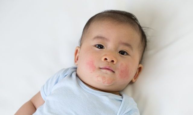 Asian baby boy lying on the bed and had a red rash on the face, Skin common rashes in newborn concept