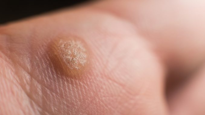 Verruca on hand, wart freeze concept, selective focus