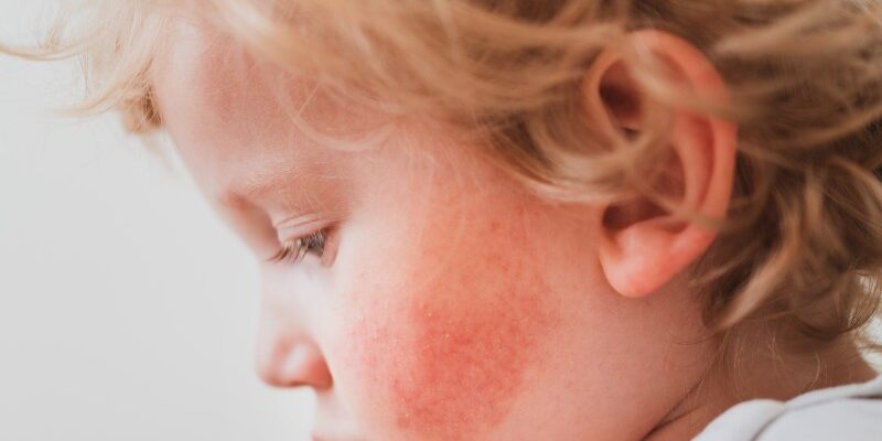 Egzema atopowa - przewlekłe zapalenie skóry o podłożu alergicznym