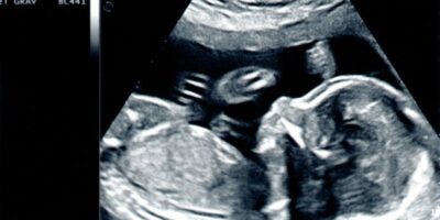 Kluczowe informacje o ultrasonografii podczas ciąży