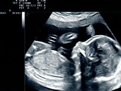 Kluczowe informacje o ultrasonografii podczas ciąży